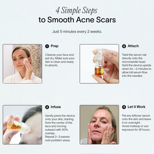 PDRN Advanced Infusion Treatment for Acne Scars