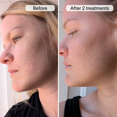 PDRN Advanced Infusion Treatment for Acne Scars