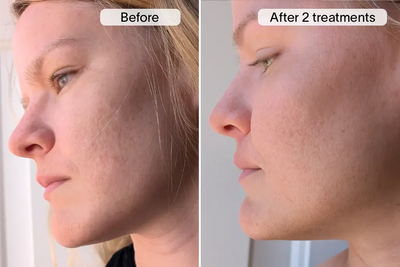 Mild Rolling Scars & Texture Irregularities