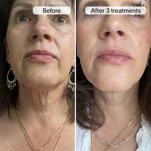 PDRN Advanced Infusion Treatment for Acne Scars