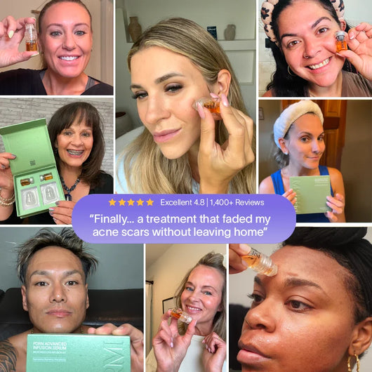 PDRN Advanced Infusion Treatment for Acne Scars