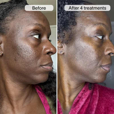 PDRN Advanced Infusion Treatment for Acne Scars