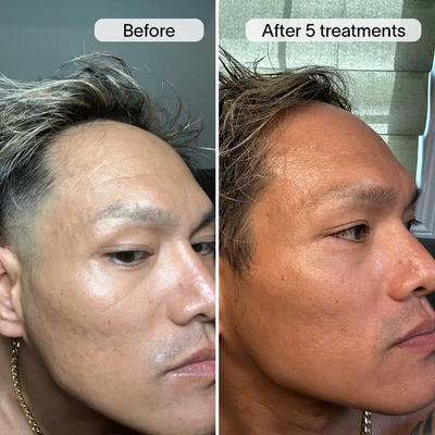 PDRN Advanced Infusion Treatment for Acne Scars