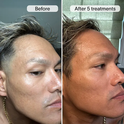 PDRN Advanced Infusion Treatment for Acne Scars