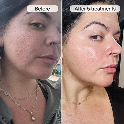 PDRN Advanced Infusion Treatment for Acne Scars